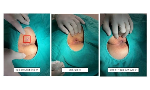 [瘺管治療 案例分享4]