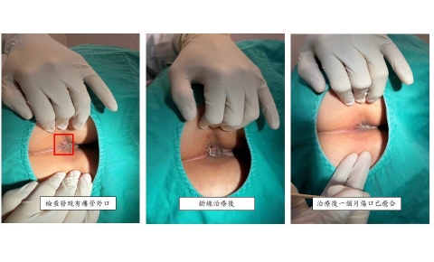 [瘺管治療 案例分享5]