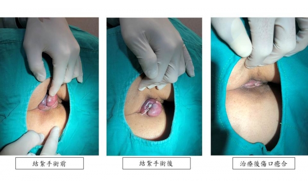 [痔瘡治療 案例分享6]