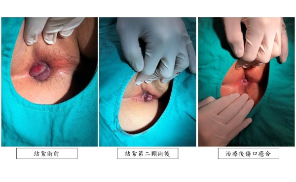 [痔瘡治療 案例分享7]