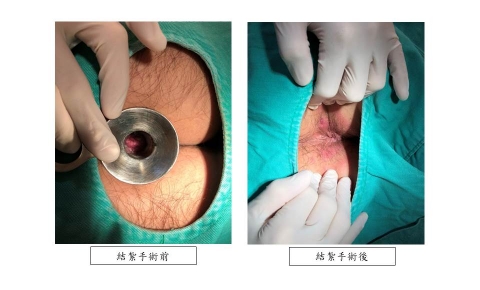[痔瘡治療 案例分享8]