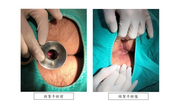 [痔瘡治療 案例分享8]