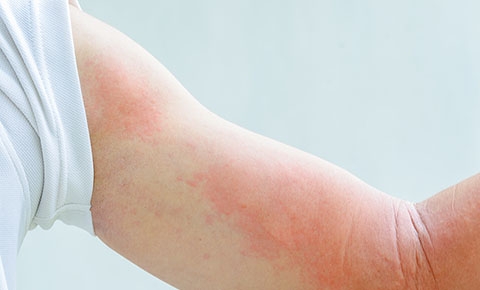 越抓越癢的皮膚紅疙瘩：蕁麻疹
