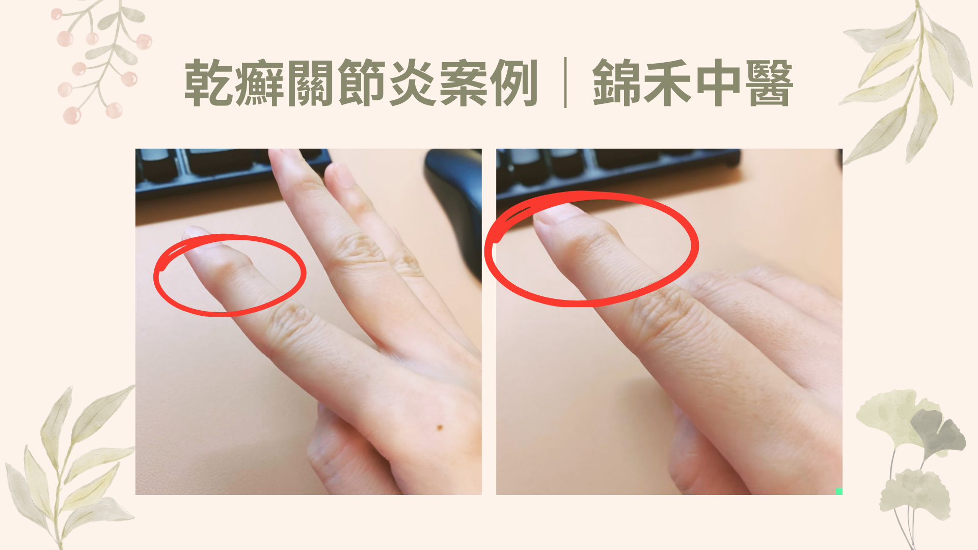 乾癬關節炎案例