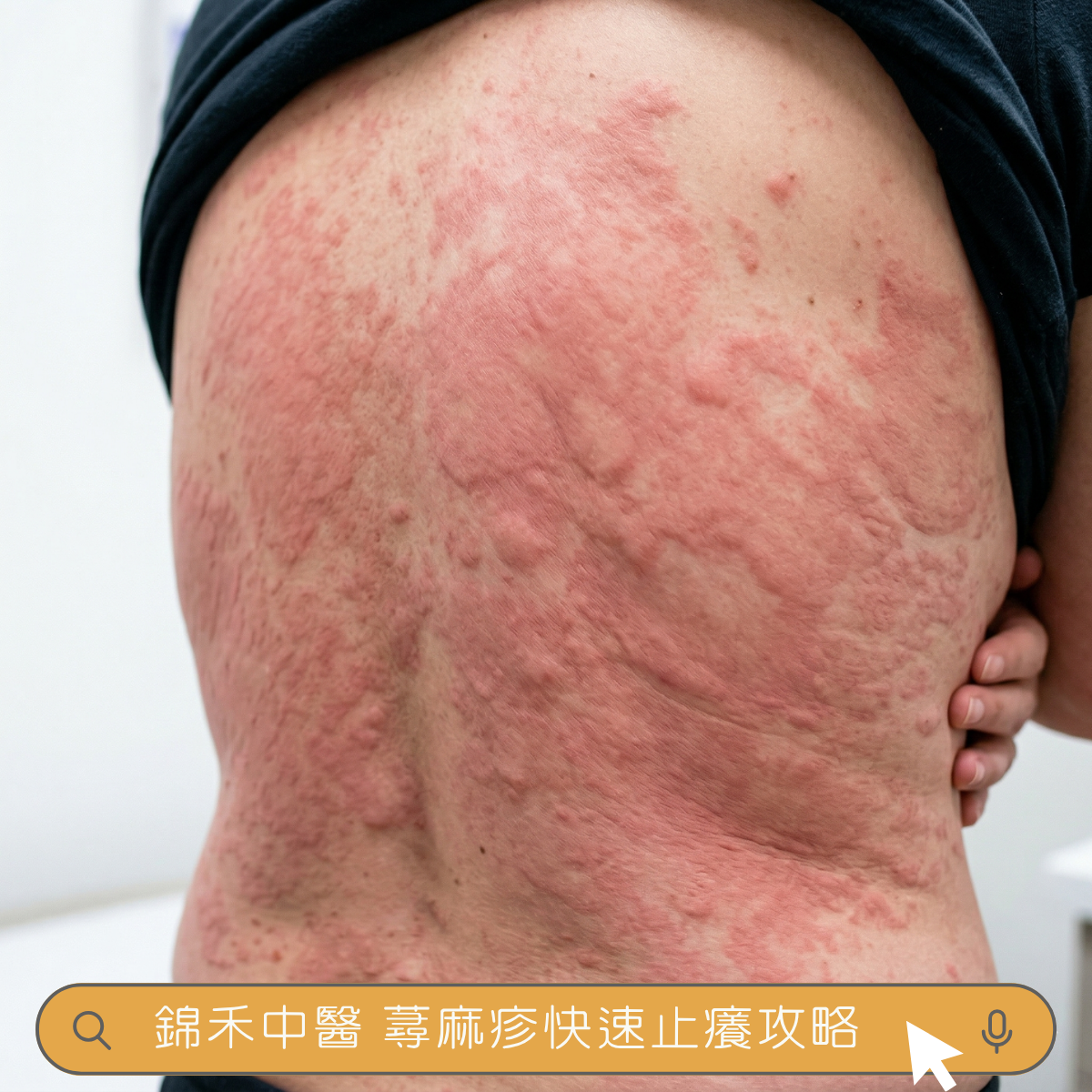 背部蕁麻疹照片