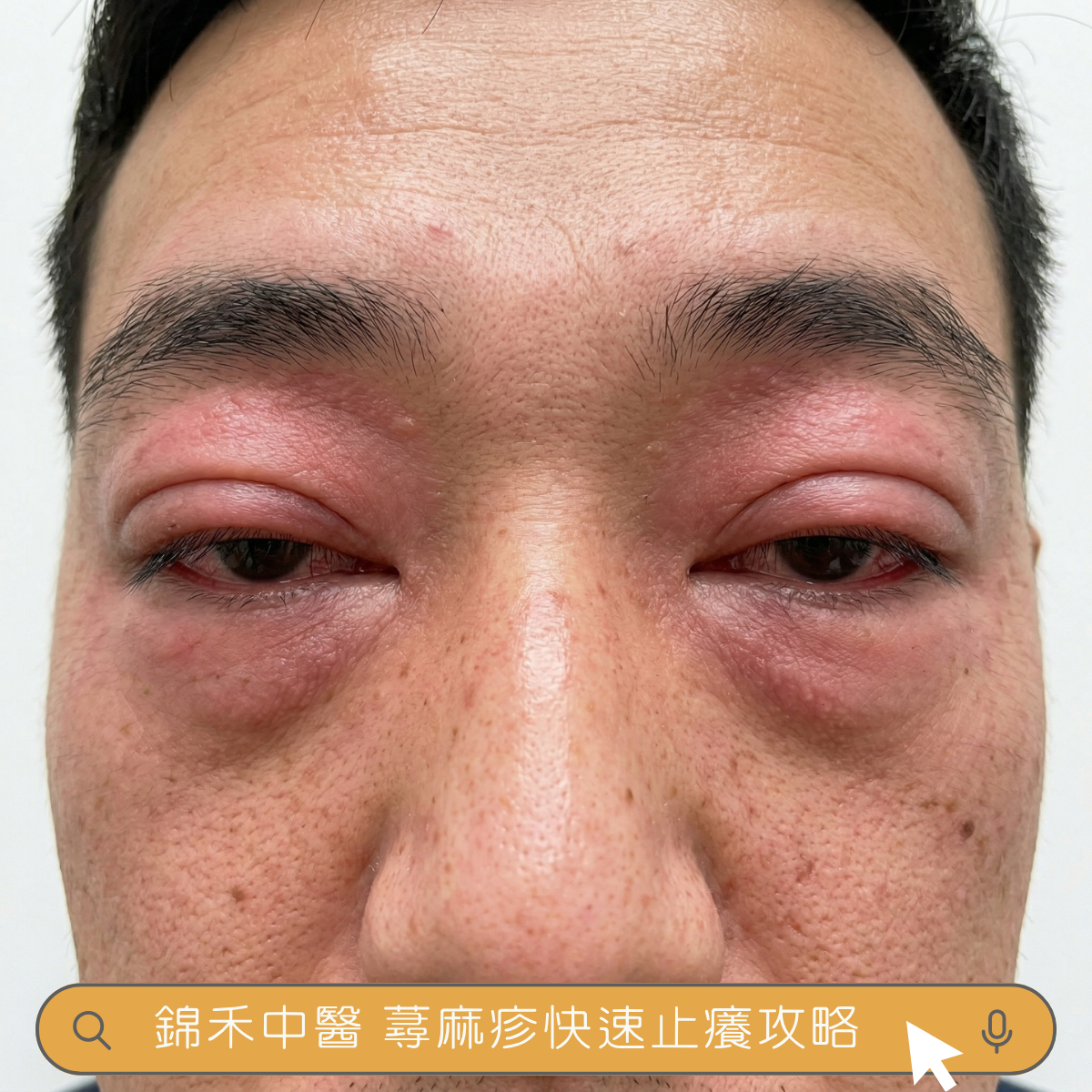 眼睛蕁麻疹照片