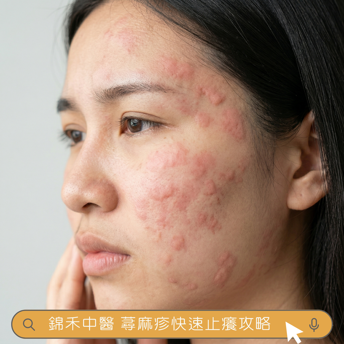 臉部蕁麻疹照片