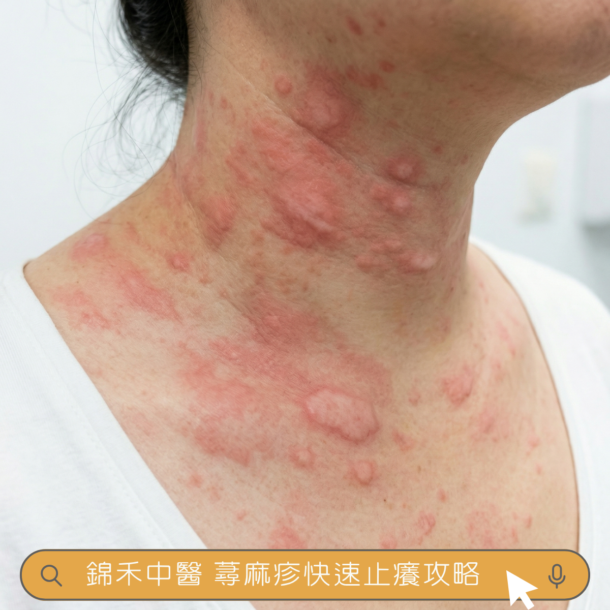 頸部蕁麻疹照片
