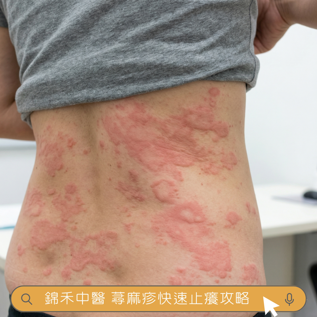 腰腹部蕁麻疹照片