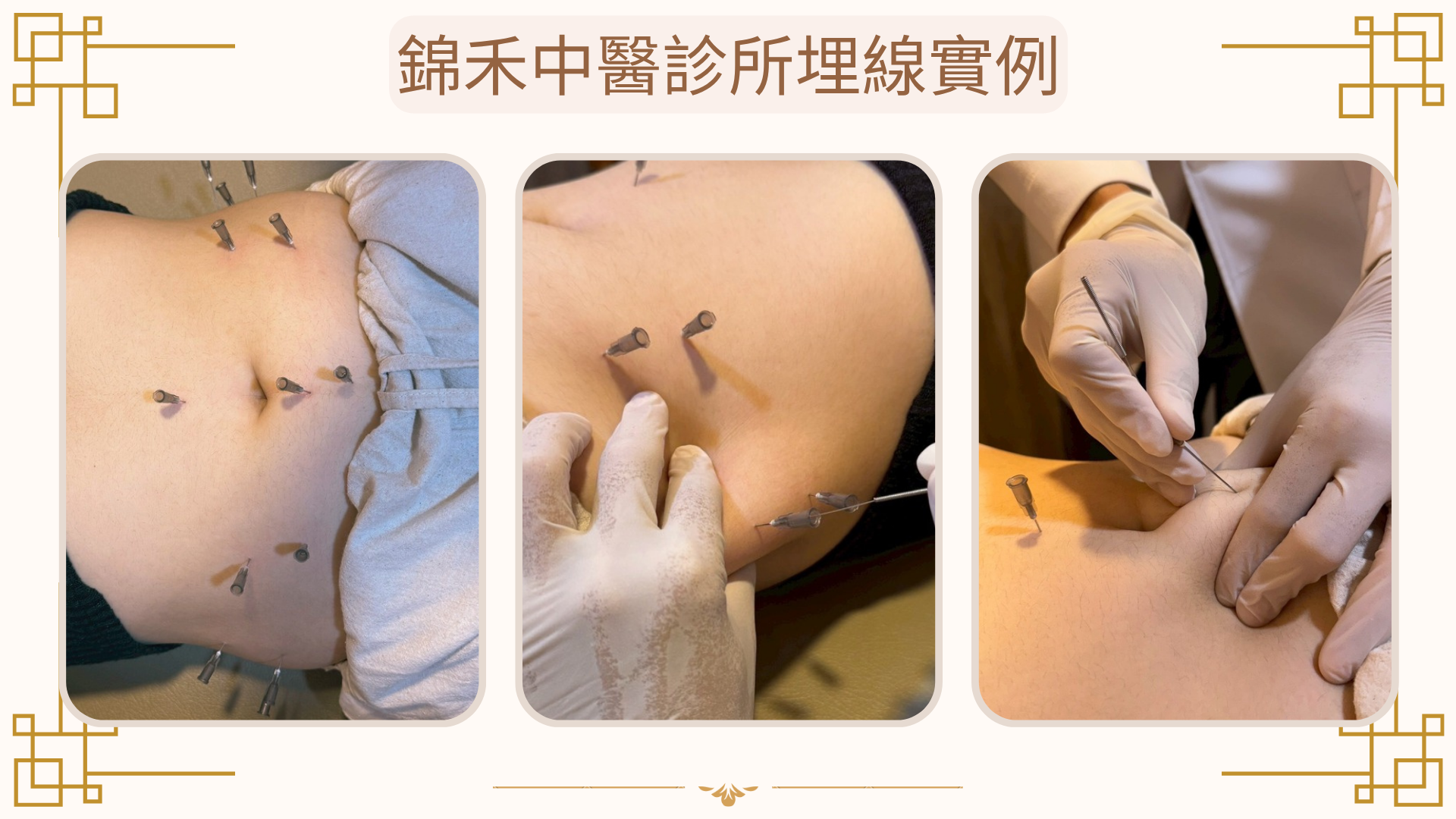埋線減肥實例